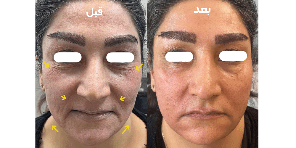 لیزر اندولیفت